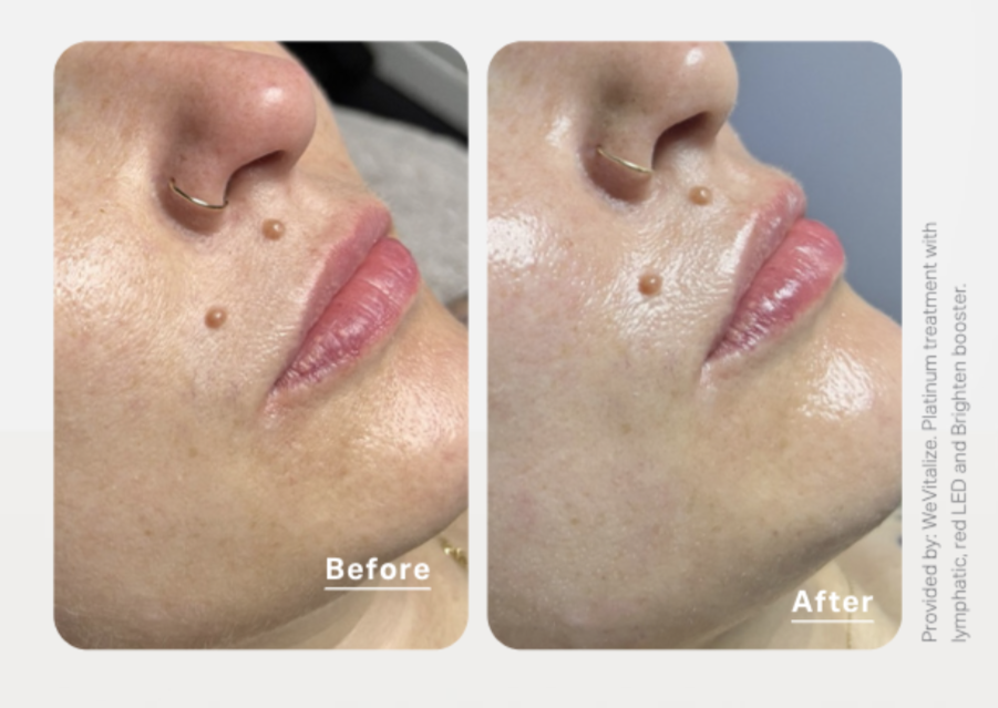 Close-ups of a patient's skin before and after a Hydrafacial in Clearwater