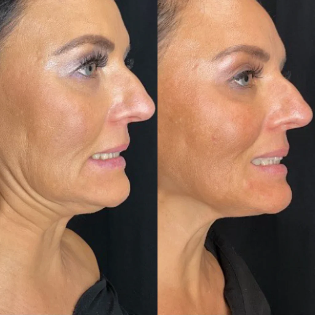 Dysport before and after