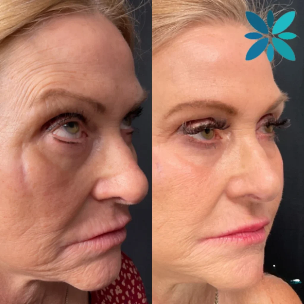 SCULPTRA before and after