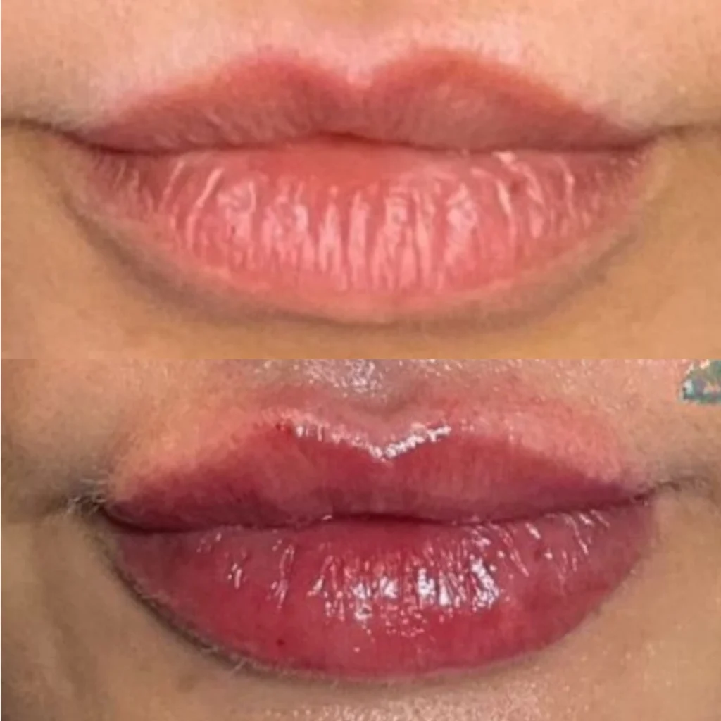 before and after lip filler