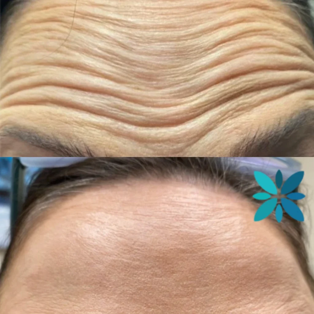 botox before and after
